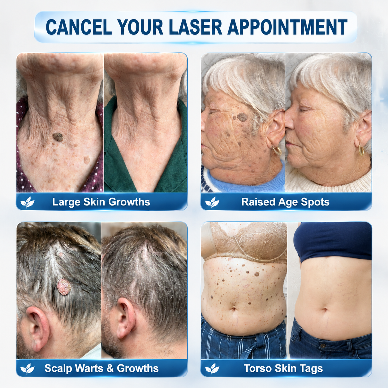 𝐇𝐈𝐒𝐊𝐈𝐍® 𝟕-𝐃𝐚𝐲 𝐓𝐚𝐠 & 𝐒𝐩𝐨𝐭 𝐄𝐫𝐚𝐬𝐞𝐫 Painless Precision Roll-On Pen🌈（for Skin Tags, Warts, Age Spots & Rough Bumps）