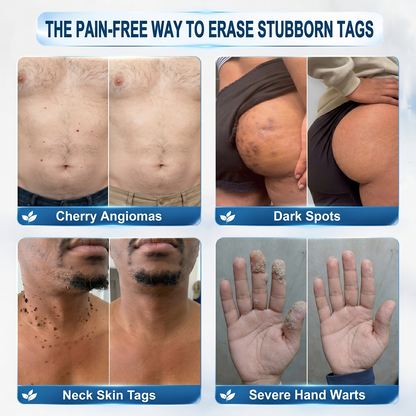𝐇𝐈𝐒𝐊𝐈𝐍® 𝟕-𝐃𝐚𝐲 𝐓𝐚𝐠 & 𝐒𝐩𝐨𝐭 𝐄𝐫𝐚𝐬𝐞𝐫 Painless Precision Roll-On Pen🌈（for Skin Tags, Warts, Age Spots & Rough Bumps）