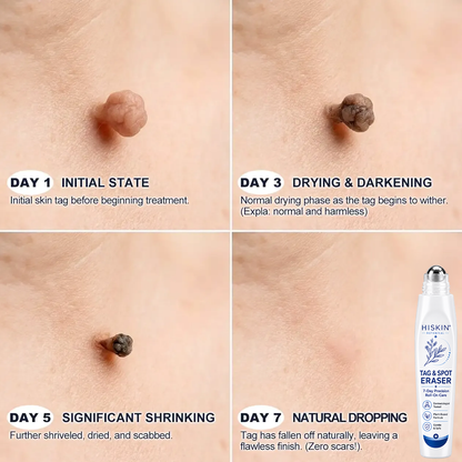 𝐇𝐈𝐒𝐊𝐈𝐍® 𝟕-𝐃𝐚𝐲 𝐓𝐚𝐠 & 𝐒𝐩𝐨𝐭 𝐄𝐫𝐚𝐬𝐞𝐫 Painless Precision Roll-On Pen🌈（for Skin Tags, Warts, Age Spots & Rough Bumps）