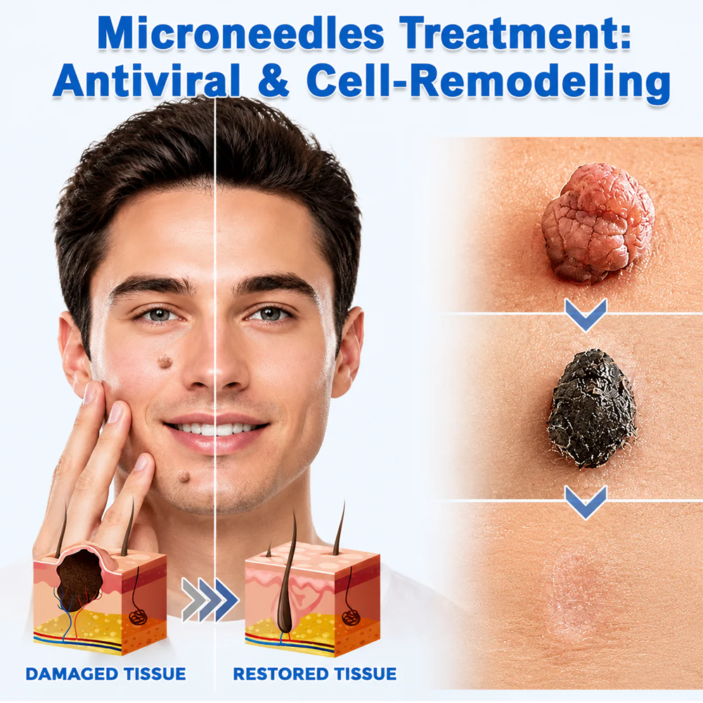 ✨Hiskin ® 2-in-1 Microneedle & Hydrocolloid Patch✨✨ | Removes raised moles, acne, flat warts, and skin tags | Helps improve wrinkles, scars, and blemishes | Invisible patches for face and body
