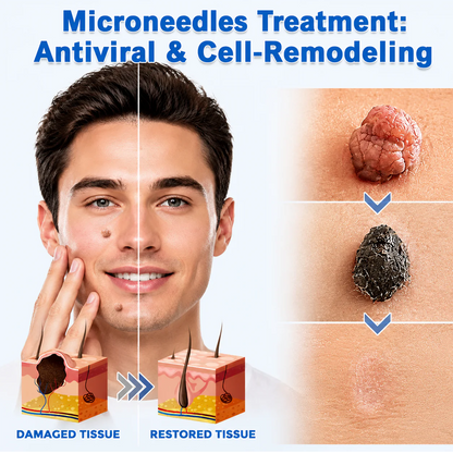 ✨Hiskin ® 2-in-1 Microneedle & Hydrocolloid Patch✨✨ | Removes raised moles, acne, flat warts, and skin tags | Helps improve wrinkles, scars, and blemishes | Invisible patches for face and body