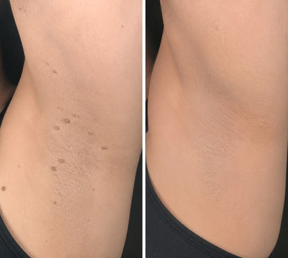✨Hiskin ® 2-in-1 Microneedle & Hydrocolloid Patch✨✨ | Removes raised moles, acne, flat warts, and skin tags | Helps improve wrinkles, scars, and blemishes | Invisible patches for face and body
