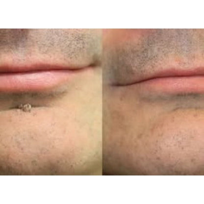 ✨Hiskin ® 2-in-1 Microneedle & Hydrocolloid Patch✨✨ | Removes raised moles, acne, flat warts, and skin tags | Helps improve wrinkles, scars, and blemishes | Invisible patches for face and body