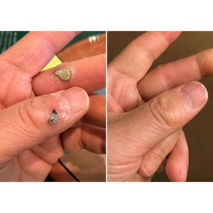 ✨Hiskin ® 2-in-1 Microneedle & Hydrocolloid Patch✨✨ | Removes raised moles, acne, flat warts, and skin tags | Helps improve wrinkles, scars, and blemishes | Invisible patches for face and body