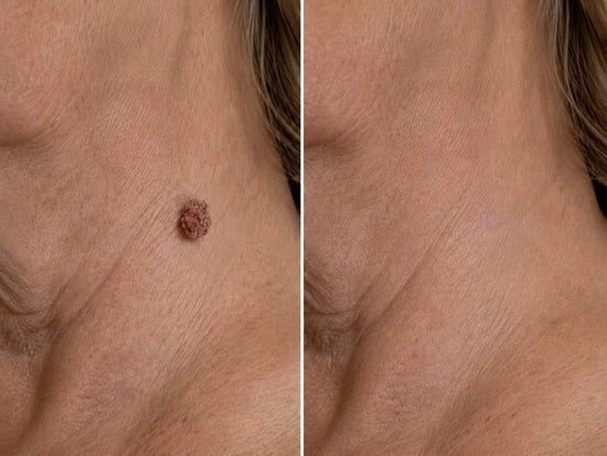 ✨Hiskin ® 2-in-1 Microneedle & Hydrocolloid Patch✨✨ | Removes raised moles, acne, flat warts, and skin tags | Helps improve wrinkles, scars, and blemishes | Invisible patches for face and body