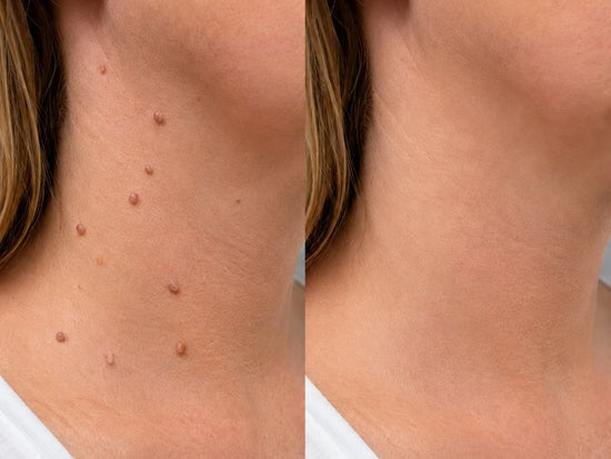 ✨Hiskin ® 2-in-1 Microneedle & Hydrocolloid Patch✨✨ | Removes raised moles, acne, flat warts, and skin tags | Helps improve wrinkles, scars, and blemishes | Invisible patches for face and body