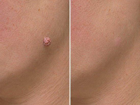 ✨Hiskin ® 2-in-1 Microneedle & Hydrocolloid Patch✨✨ | Removes raised moles, acne, flat warts, and skin tags | Helps improve wrinkles, scars, and blemishes | Invisible patches for face and body